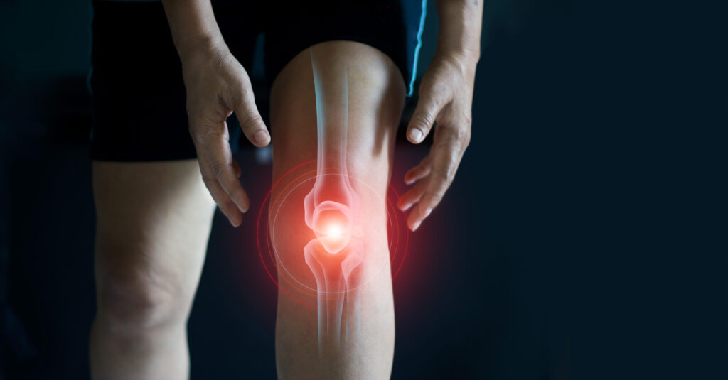 Inflammation-in-knee-from-arthritis